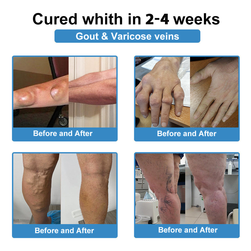 Official Store 🏃♀️ Recommended by AOA 💪Thonesr® Nano-microneedle joint patch (Painless, long-lasting, suitable for arthritis, varicose veins and various orthopedic diseases)【Last 30 min Flash Sale】