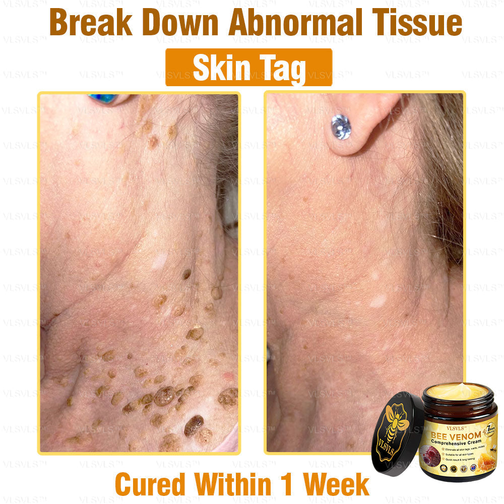 VLSVLS™ Bee Venom Comprehensive Cream 🎉🎉(Suitable for all ages & TGA recommends)