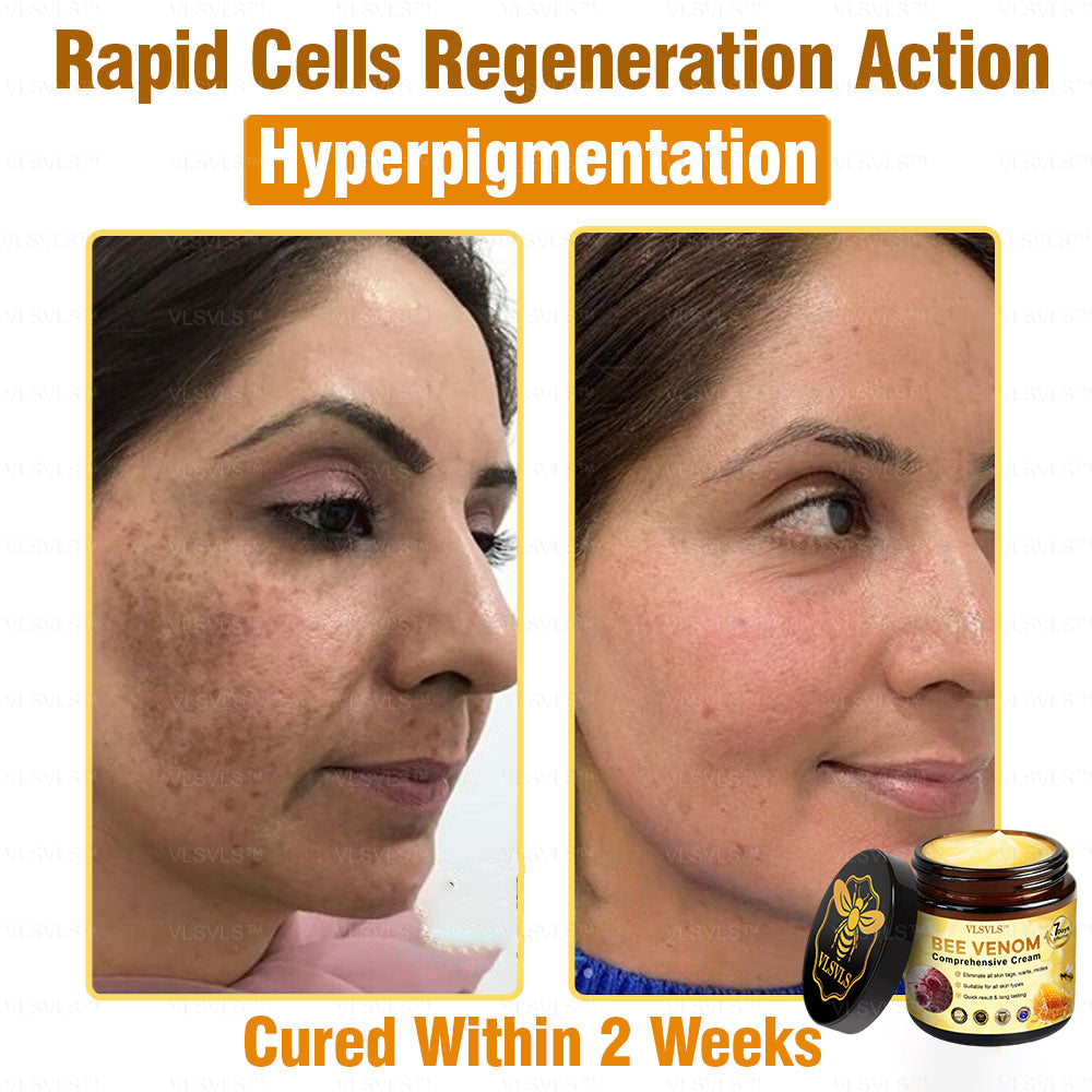 VLSVLS™ Bee Venom Comprehensive Cream 🎉🎉(Suitable for all ages & TGA recommends)