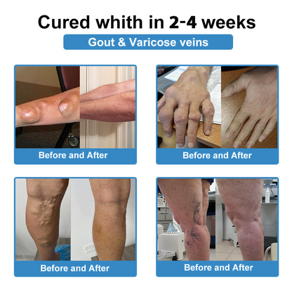 Official Store 🏃‍♀️ Recommended by AOA 💪Thonesr® Nano-microneedle joint patch (Painless, long-lasting, suitable for arthritis, varicose veins and various orthopedic diseases)【Last 30 min Flash Sale】