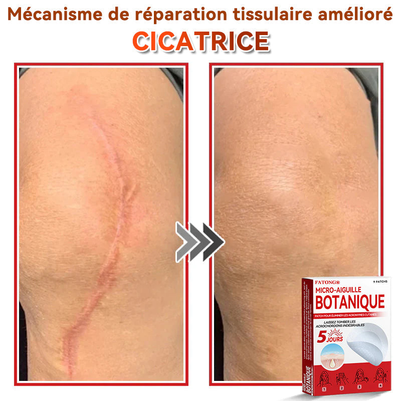 𝐅𝐀𝐓𝐎𝐍𝐆® 𝐌𝐢𝐜𝐫𝐨-𝐀𝐢𝐠𝐮𝐢𝐥𝐥𝐞 𝐁𝐨𝐭𝐚𝐧𝐢𝐪𝐮𝐞 𝐏𝐚𝐭𝐜𝐡 𝐏𝐨𝐮𝐫 É𝐥𝐢𝐦𝐢𝐧𝐞𝐫 𝐋𝐞𝐬 𝐀𝐜𝐫𝐨𝐧𝐲𝐦𝐞𝐬 𝐂𝐮𝐭𝐚𝐧é𝐬 🇺🇸 Fabriqué en France🍁💖