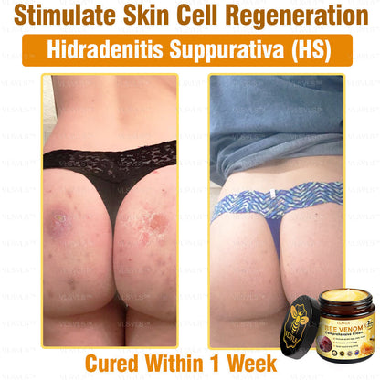 VLSVLS™ Bee Venom Comprehensive Cream 🎉🎉(Suitable for all ages & TGA recommends)