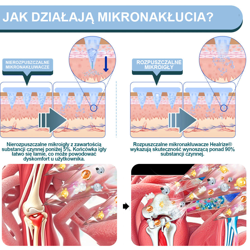 Oficjalny sklep：👨‍⚕️𝐇𝐞𝐚𝐥𝐫𝐢𝐳𝐞® Nano-wprowadzająca terapia stawów (bezbolesna, długotrwała, stosowana w przypadku zapalenia stawów, żylaków i różnych schorzeń ortopedycznych)