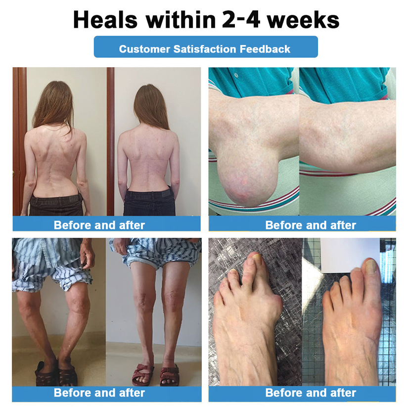 Official Store 🏃‍♀️ Recommended by AOA 💪Thonesr® Nano-microneedle joint patch (Painless, long-lasting, suitable for arthritis, varicose veins and various orthopedic diseases)【Last 30 min Flash Sale】