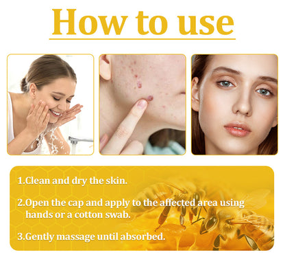 Turonu™ 𝐁𝐞𝐞 𝐕𝐞𝐧𝐨𝐦 𝐒𝐤𝐢𝐧 𝐓𝐫𝐞𝐚𝐭𝐦𝐞𝐧𝐭 𝐂𝐫𝐞𝐚𝐦🐝（CDA 𝑅𝑒𝑐𝑜𝑚𝑚𝑒𝑛𝑑𝑒𝑑） (⏰𝑳𝒂𝒔𝒕 𝒅𝒂𝒚 𝒑𝒓𝒐𝒎𝒐𝒕𝒊𝒐𝒏 80% 𝒐𝒇𝒇)