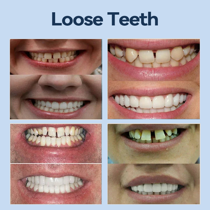 【Last Day Promotion 60% OFF🏆】 Bikenda® 𝐏𝐫𝐞𝐦𝐢𝐮𝐦 𝐃𝐞𝐧𝐭𝐮𝐫𝐞 - (✨Suitable for all mouth shapes, custom-made dentures for a perfect fit✨）