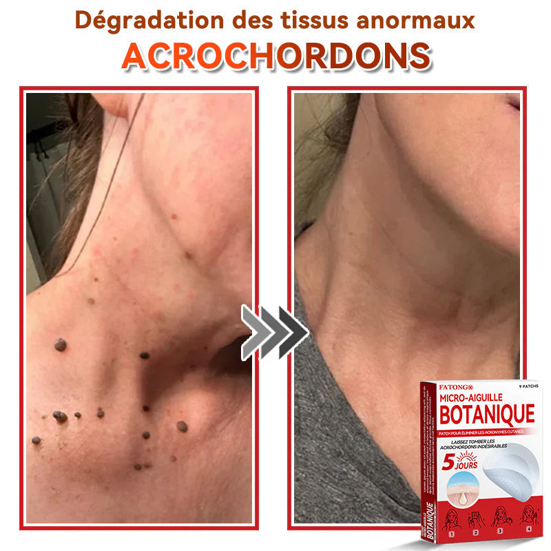 𝐅𝐀𝐓𝐎𝐍𝐆® 𝐌𝐢𝐜𝐫𝐨-𝐀𝐢𝐠𝐮𝐢𝐥𝐥𝐞 𝐁𝐨𝐭𝐚𝐧𝐢𝐪𝐮𝐞 𝐏𝐚𝐭𝐜𝐡 𝐏𝐨𝐮𝐫 É𝐥𝐢𝐦𝐢𝐧𝐞𝐫 𝐋𝐞𝐬 𝐀𝐜𝐫𝐨𝐧𝐲𝐦𝐞𝐬 𝐂𝐮𝐭𝐚𝐧é𝐬 🇺🇸 Fabriqué en France🍁💖