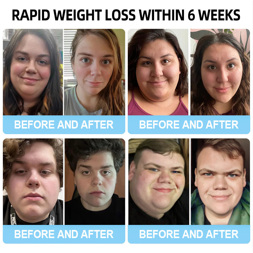 [Lmipki® Official Store】👨🏻‍⚕️𝐍𝐚𝐧𝐨 𝐌𝐢𝐜𝐫𝐨𝐧𝐞𝐞𝐝𝐥𝐞 𝐏𝐚𝐭𝐜𝐡 𝐰𝐢𝐭𝐡 𝐒𝐌𝐆𝐓-𝐆𝐋𝐏-𝟏&𝐌𝐚𝐭𝐫𝐢𝐱𝐲丨𝟑𝟎𝟎𝟎-𝐒𝐥𝐢𝐦𝐦𝐢𝐧𝐠, 𝐒𝐤𝐢𝐧 𝐓𝐢𝐠𝐡𝐭𝐞𝐧𝐢𝐧𝐠, 𝐁𝐥𝐨𝐨𝐝 𝐒𝐮𝐠𝐚𝐫 𝐒𝐮𝐩𝐩𝐨𝐫𝐭, 𝐍𝐨 𝐈𝐧𝐣𝐞𝐜𝐭𝐢𝐨𝐧, 𝟕-𝐃𝐚𝐲 𝐑𝐞𝐬𝐮𝐥𝐭