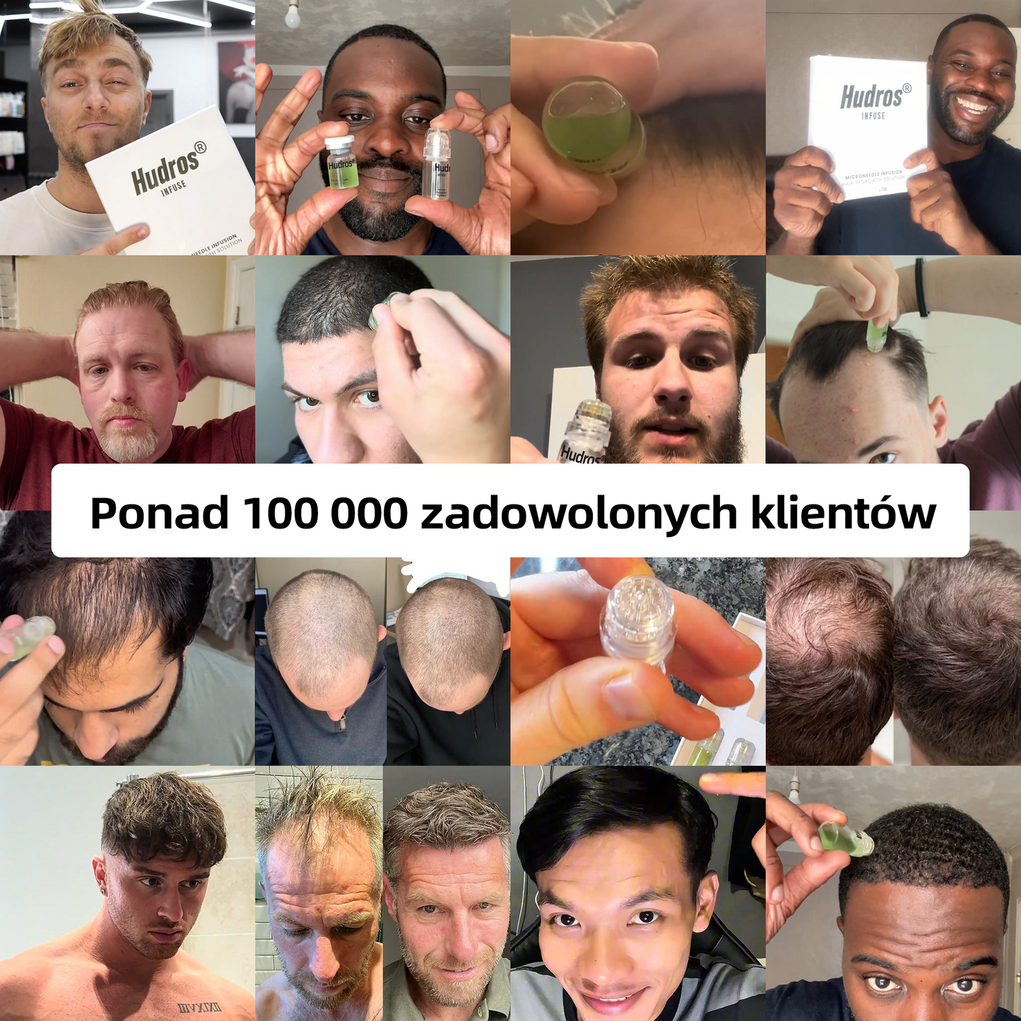 [Oferta specjalna noworoczna] System odrastania włosów Hudros®👩‍⚕️Przywróć swoim włosom idealny wygląd