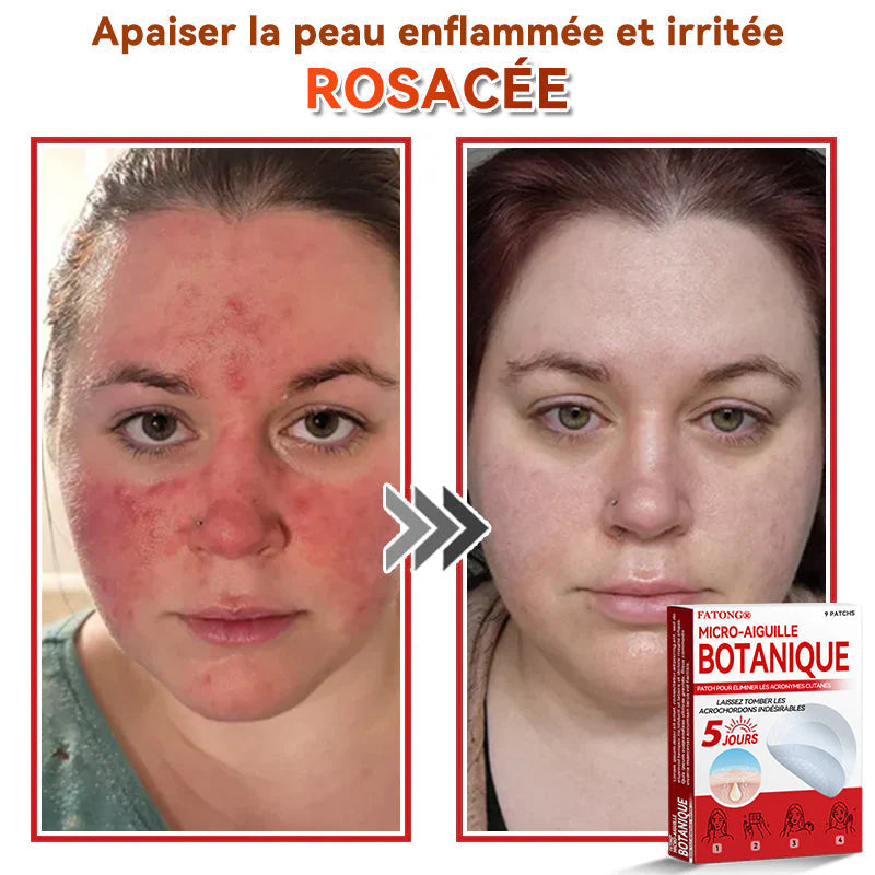 𝐅𝐀𝐓𝐎𝐍𝐆® 𝐌𝐢𝐜𝐫𝐨-𝐀𝐢𝐠𝐮𝐢𝐥𝐥𝐞 𝐁𝐨𝐭𝐚𝐧𝐢𝐪𝐮𝐞 𝐏𝐚𝐭𝐜𝐡 𝐏𝐨𝐮𝐫 É𝐥𝐢𝐦𝐢𝐧𝐞𝐫 𝐋𝐞𝐬 𝐀𝐜𝐫𝐨𝐧𝐲𝐦𝐞𝐬 𝐂𝐮𝐭𝐚𝐧é𝐬 🇺🇸 Fabriqué en France🍁💖