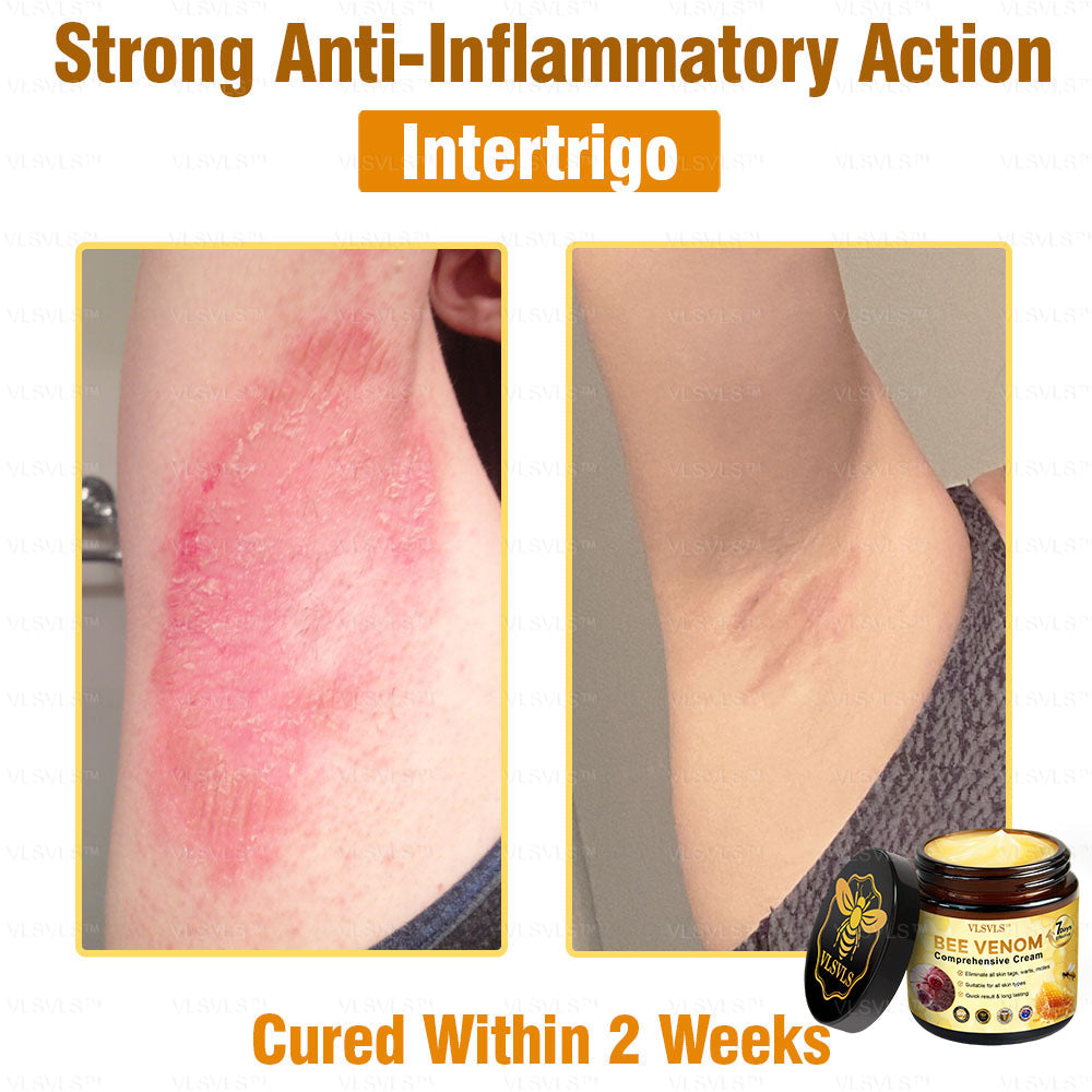 VLSVLS™ Bee Venom Comprehensive Cream 🎉🎉(Suitable for all ages & TGA recommends)