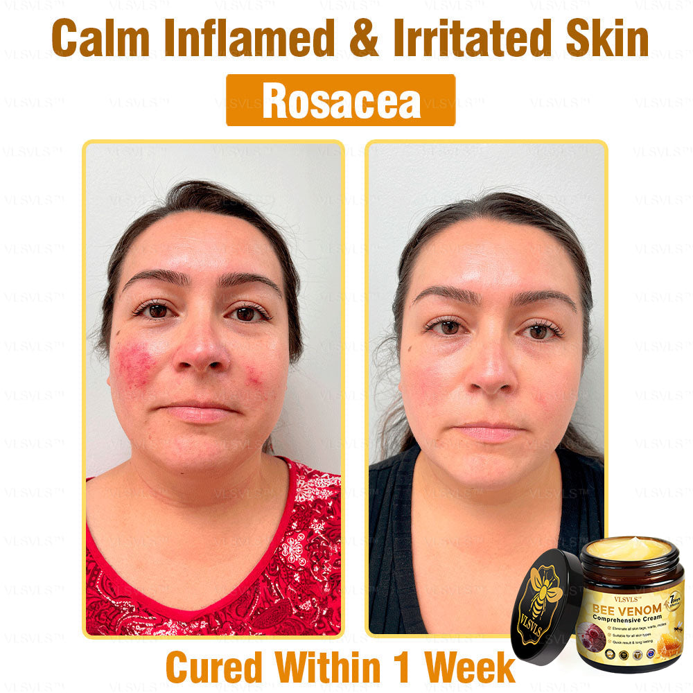 VLSVLS™ Bee Venom Comprehensive Cream 🎉🎉(Suitable for all ages & TGA recommends)
