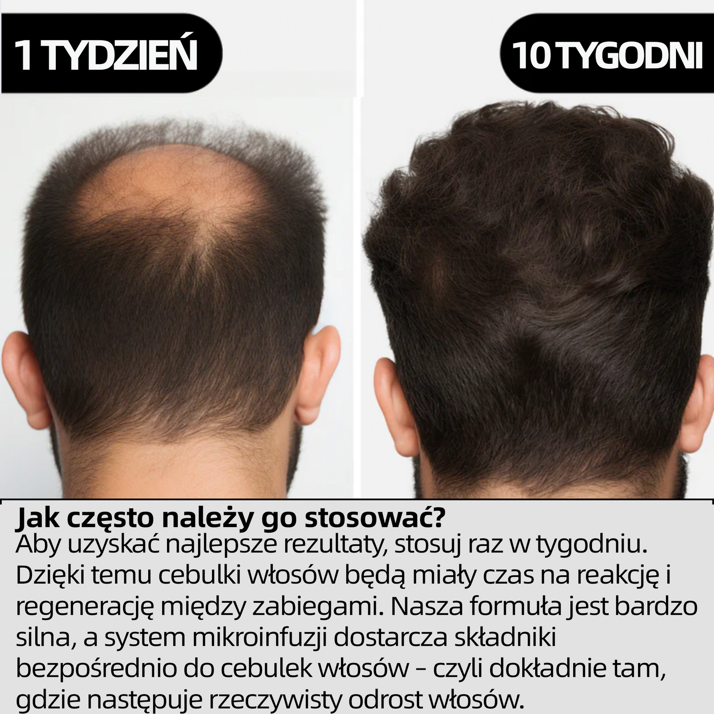 [Oferta specjalna noworoczna] System odrastania włosów Hudros®👩‍⚕️Przywróć swoim włosom idealny wygląd