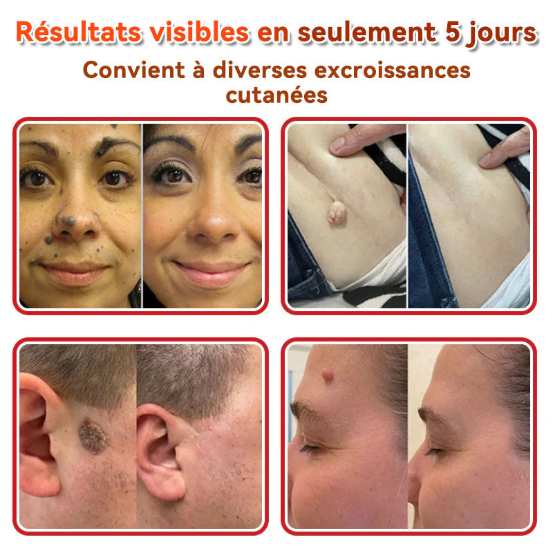 𝐅𝐀𝐓𝐎𝐍𝐆® 𝐌𝐢𝐜𝐫𝐨-𝐀𝐢𝐠𝐮𝐢𝐥𝐥𝐞 𝐁𝐨𝐭𝐚𝐧𝐢𝐪𝐮𝐞 𝐏𝐚𝐭𝐜𝐡 𝐏𝐨𝐮𝐫 É𝐥𝐢𝐦𝐢𝐧𝐞𝐫 𝐋𝐞𝐬 𝐀𝐜𝐫𝐨𝐧𝐲𝐦𝐞𝐬 𝐂𝐮𝐭𝐚𝐧é𝐬 🇺🇸 Fabriqué en France🍁💖